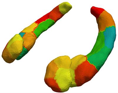 A 7 Tesla Amygdalar-Hippocampal Shape Analysis of Lithium Response in Bipolar Disorder